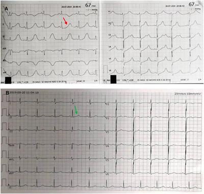 Case Report: An Unusual Case of Pheochromocytoma